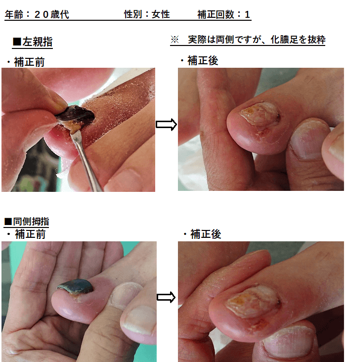 巻き爪　2枚爪・化膿・棘　